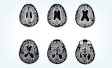 MS Causes and Solutions